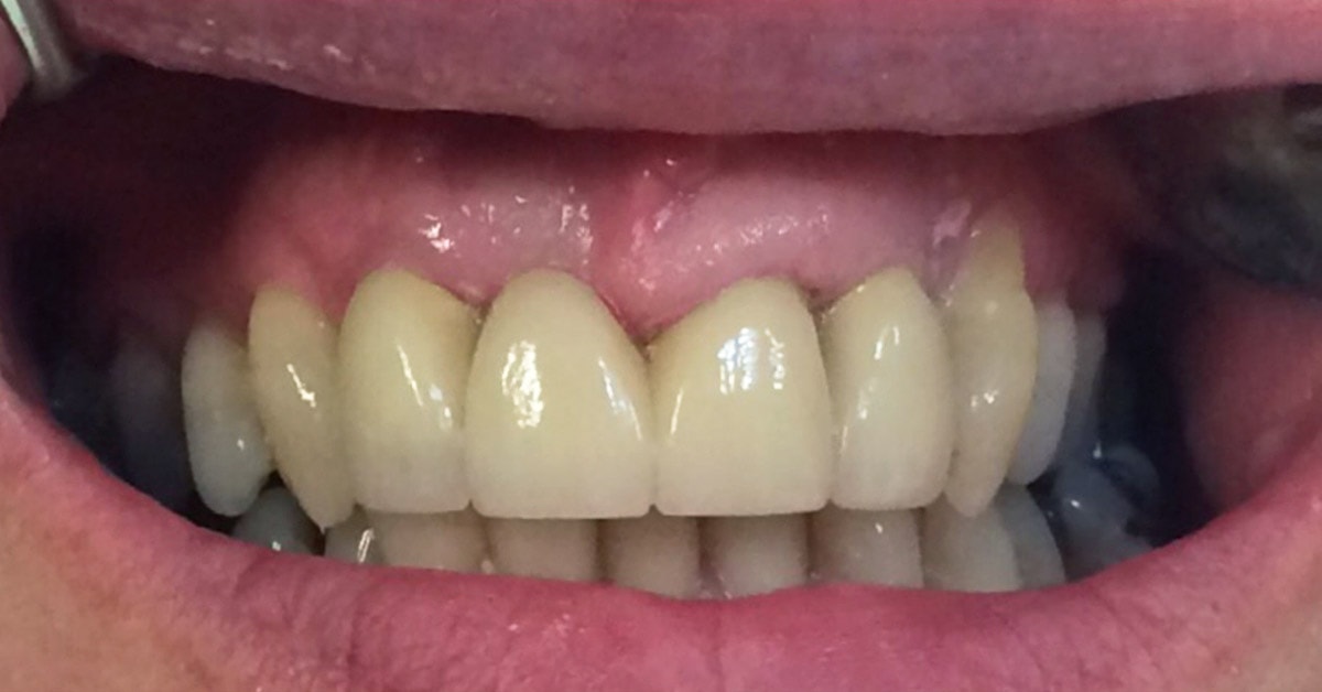 Tooth Repair - Dental Bridge Case Study